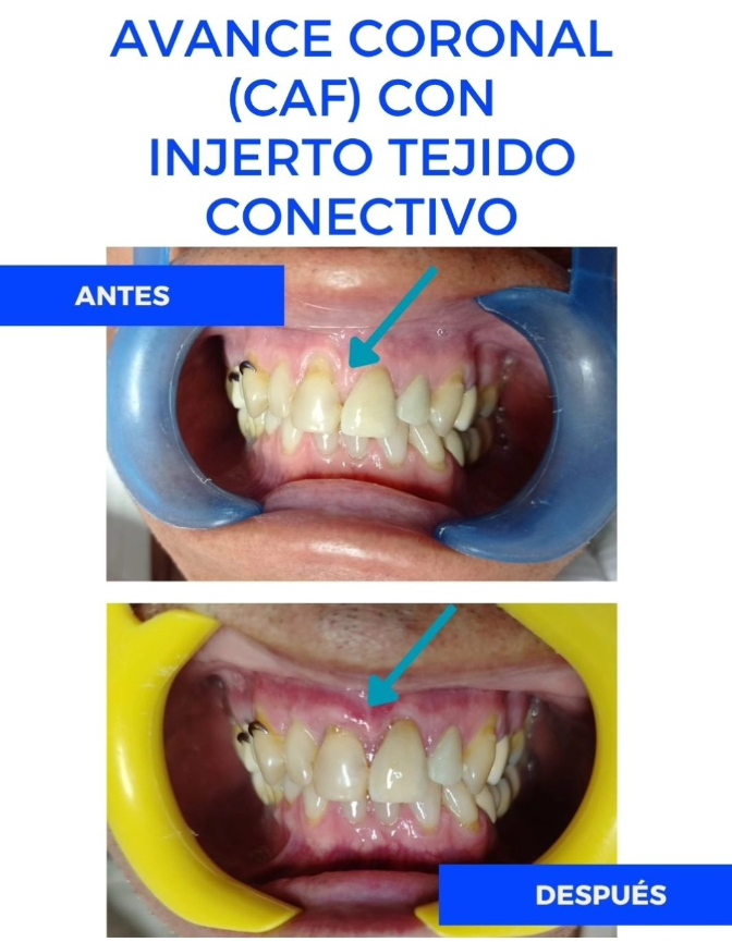 Caso de tratamiento de manchas y coloracion dental, resultado de blanqueamiento profesional
