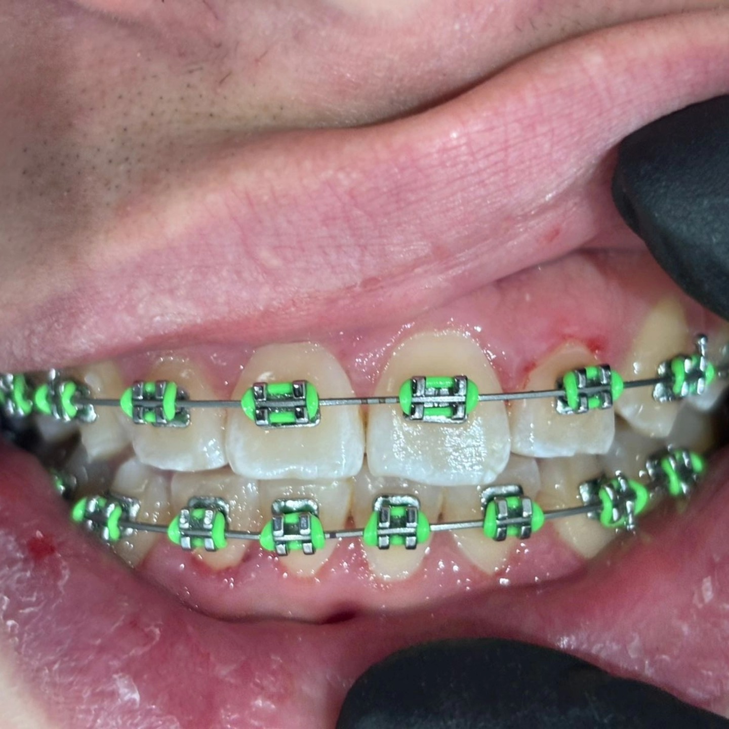 Caso de ortodoncia, alineacion dental con brackets, antes y despues del tratamiento