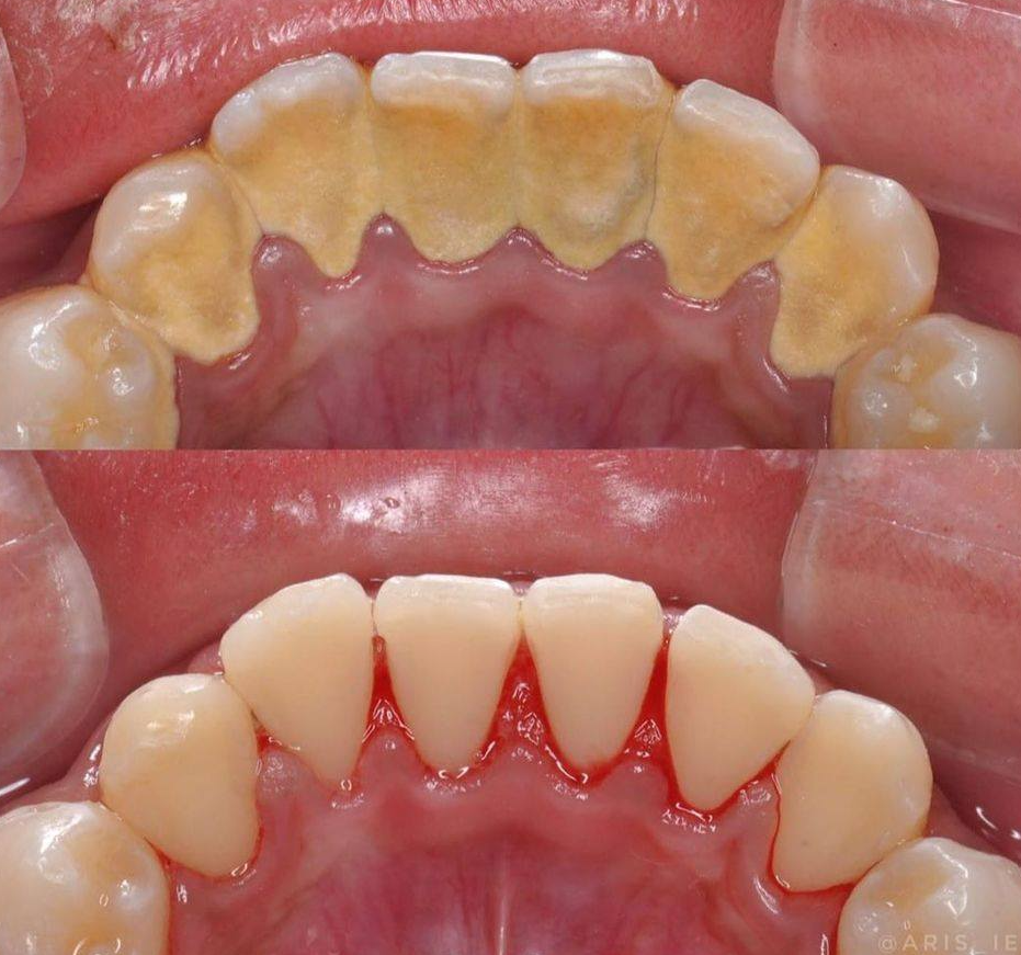 Caso de limpieza dental y retiro de sarro, antes y despues del tratamiento profesional